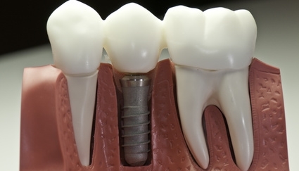 dental-implants-grants-pass-oregon.jpg