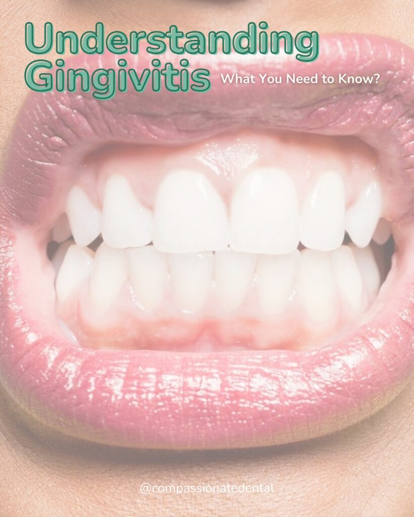 Understanding Gingivitis